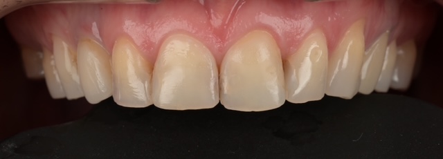 Anterior Restoration